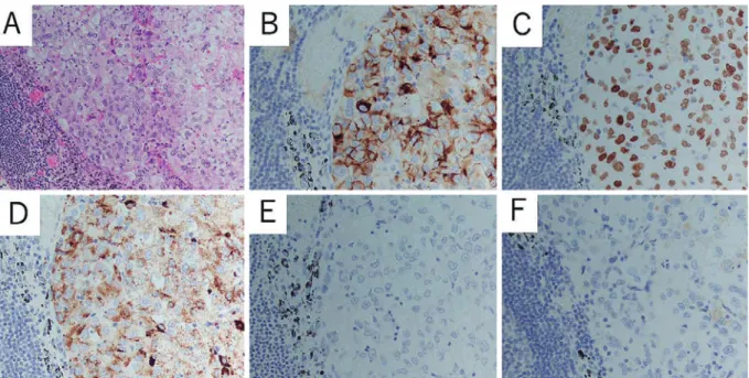 Figure   5   Microscopic findings of the resected specimen.