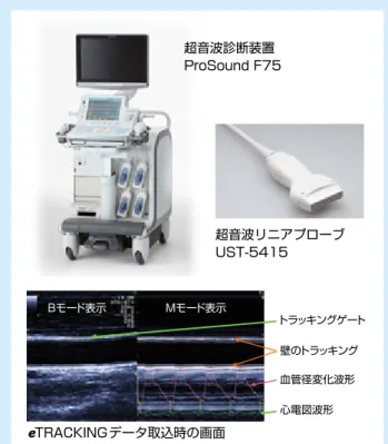 図 4：eTRACKING搭載製品の一例eTRACKINGデータ取込時の画面 超音波リニアプローブUST-5415 トラッキングゲート壁のトラッキング血管径変化波形Bモード表示Mモード表示心電図波形超音波診断装置ProSound F75トラッキングゲートのゼロクロス位置は、図3に示すように、超音波受信周波数の16倍のクロックを用いて計測する。16倍の周波数のクロックとは、超音波受信信号の1波を16分割することに相当する。超音波受信周波数が10MHzとすると、1波長は0.15mmで、16分の1は約0.01mm