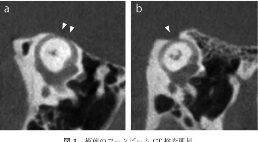 図 2 経乳突洞的上半規管裂隙へのアプローチ 外側半規管を同定し，その上方に位置する上半規管へアプローチす る．低天蓋の場合は内視鏡とドリルの挿入スペースが狭くなる．裂隙 が後方に位置する場合は予め弓下動脈を処理しておく． SA ；弓下動脈， SPS；上錐体洞，PSCC；後半規管，LSCC；外側半規管，M；ツチ骨， I；キヌタ骨，破線；上半規管裂隙の部位（中頭蓋硬膜と上錐体静脈 洞の場合を示す．） 図 1 術前のコーンビーム CT 検査所見