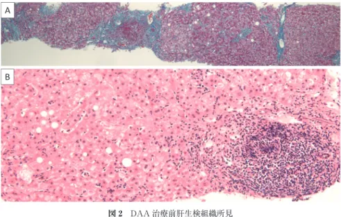 図 2 DAA 治療前肝生検組織所見 ⾨脈域を中心とし，中心静脈へ向かって小葉のひずみを伴った線維化を認めた．⾨脈域 にリンパ球を中心とした炎症細胞浸潤を認め，リンパ濾胞を形成していた．また一部で は脂肪滴が沈着し，Ballooning を伴う部位も認めた．不規則な再生性変化を伴っており C 型慢性肝炎に矛盾しない像を呈していた． A：Azan 染色，B：Hematoxylin-Eosin 染色 AB 図 3 臨床経過 肝生検で新犬山分類 A2F3 のウイルス性肝炎であることを確認後に  Ledipas-v