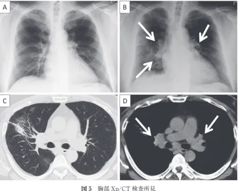 図 5 胸部 Xp/CT 検査所見 DAA 治療前の胸部 Xp 検査（A）と比較して，DAA 治療後の胸部 Xp 検査（B）で 両側肺⾨リンパ節腫脹（矢印）が出現していた．また胸部 CT 検査（C，D）では気 管支血管周囲間質や小葉間隔壁が肥厚し，右上中肺野優位に微細粒状に集簇した陰影 や肺⾨部リンパ節腫脹（矢印）を認めた．A B DC 図 6 FDG-PET 画像 両側肺の粒状影部および肺⾨リンパ節，気管分岐部リ ンパ節などに FDG の集積を認めた． 図 7 気管支鏡検査 経気管支肺生検では小さな類上皮