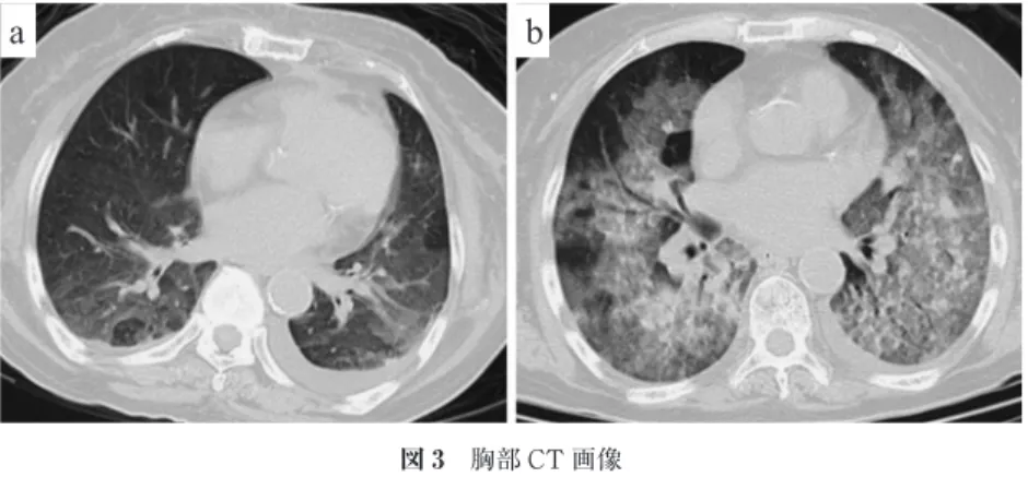 図 3 胸部 CT 画像 a）入院時，両肺野にすりガラス影を認める． b）3 日後，すりガラス影は拡大し，一部 consolidation も伴っている．ab 図 4 脾臓の肉眼的および顕微鏡的所見 標本の表面（a）や割面（b）に白色調の壊死巣を認める．脾組織のヘマトキシリン・エオジン（HE）染色で，異型細 胞がびまん性に増殖している［（c）原倍率×40，（d）原倍率×400］．免疫組織染色で，腫瘍細胞は CD20（e）と CD79a（f）が陽性である（原倍率×100）． dc efab 化した．第 14 