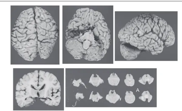 Fig. 6 Frontal cortex : neuronal loss and atrophy (a : LFB), sponginess (b : H-E), LB-neuritic change (c〜d : α-synuclein), LB (e : α-synuclein, f : H-E)