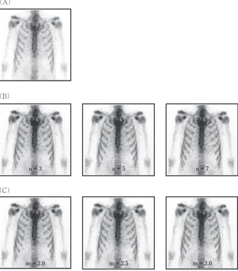 Fig .   5   Application of our image processing method to the clinical image  ( chest bone scintigram of anterior view ).( A )  Original image .( B ) Processing image with Butterworth filter  ( cut - off frequency ;  0.25 cycle/pixel ,  order ;  3,   5,   