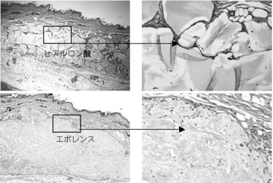 図 2　エボレンスとヒアルロン酸注入 1 ヵ月後の病理像