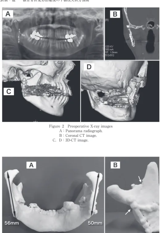 Figure 3　Plaster 3-dimensional （3D） model