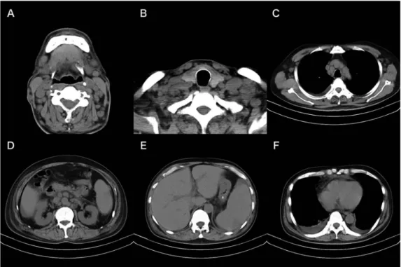 Fig. 1.  Computed tomography images upon admission. Image shows systemic lymphadenopathy (A-D), hepatosplenomegaly,  ascites (E), and bilateral pleural eﬀusions (F).