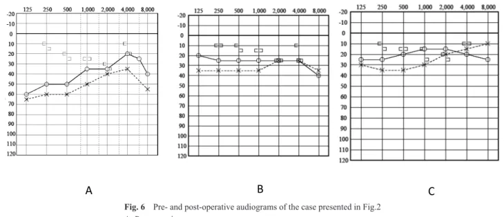 Fig. 6  Pre- and post-operative audiograms of the case presented in Fig.2 A. Pre-operation