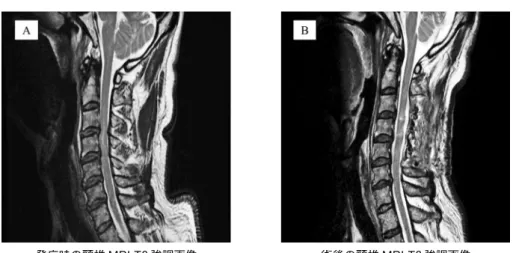 図 1　脊髄 MRI（T2 強調画像）