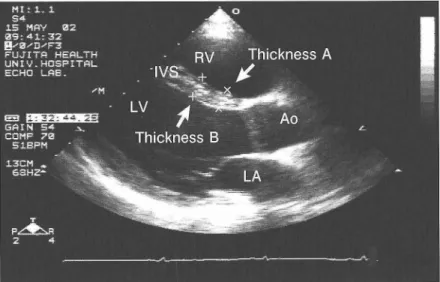 Figure  5.  The  distribution  of  thickness  A.