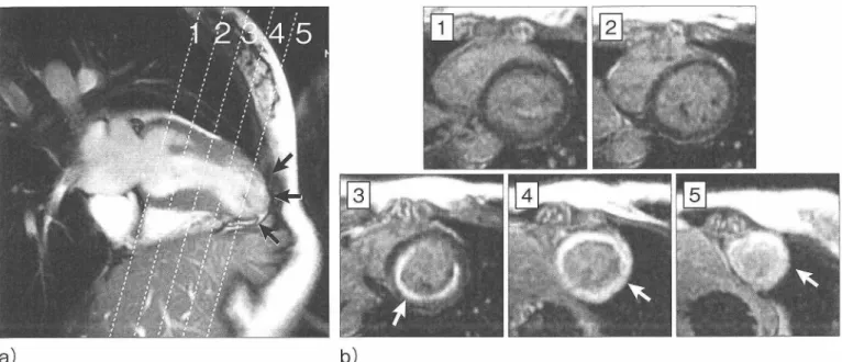 Figure  7.  An  asymptomatic  22  years-old  woman  who  was  pointed-out  ECG  abnormality  and  abnormal  lung  shadow  on  chest  X  ray  in  medical  checkup  and  diagnosed  histologically  lung  sarcoidosis  with  TBLB