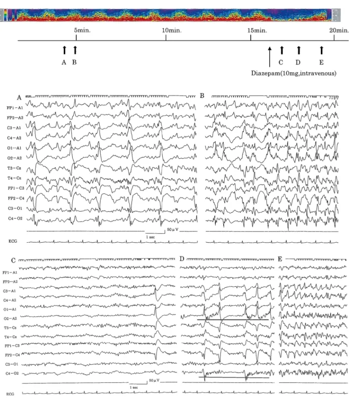 Fig. 2 The electroencephalogram of the patient.