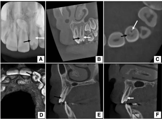 Figure 2　複数の陥入部位を持つ歯内歯の口内法 X 線画像と歯科用 CBCT 画像。上顎前歯部の口内法 X 線画像（A）。上顎左側側切歯の内部に西洋なし様の形態を持つエナメル質と象牙質の陥凹，その内 部に髄腔様空洞を認める（A 白・黒矢印）。歯科用 CBCT 画像の panorama section 像（B）では歯様 構造物（エナメル質，象牙質および髄腔様空洞）が陥入している領域を 2 か所認める（B 白・黒矢印）。