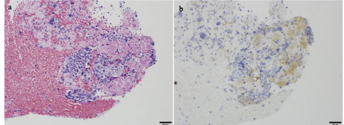 Fig. 4. PD-L1 expression in the EUS-FNA samples.