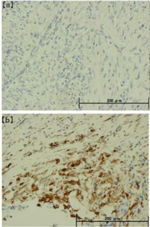 Figure 3. Immunostaining of NSCs. (a) E-cadherin immunostaining was negative, (b) vimentin immunostaining was positive (×200)