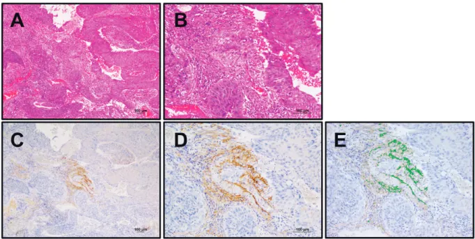 Fig. 1.  Representative images of lung adenocarcinomas. A. Hematoxylin and eosin stained section ( × 40)