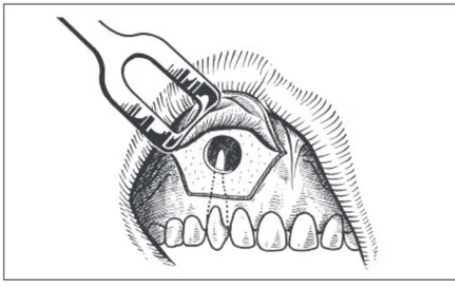 図 45　angled arched incision（文献 57 より引用）