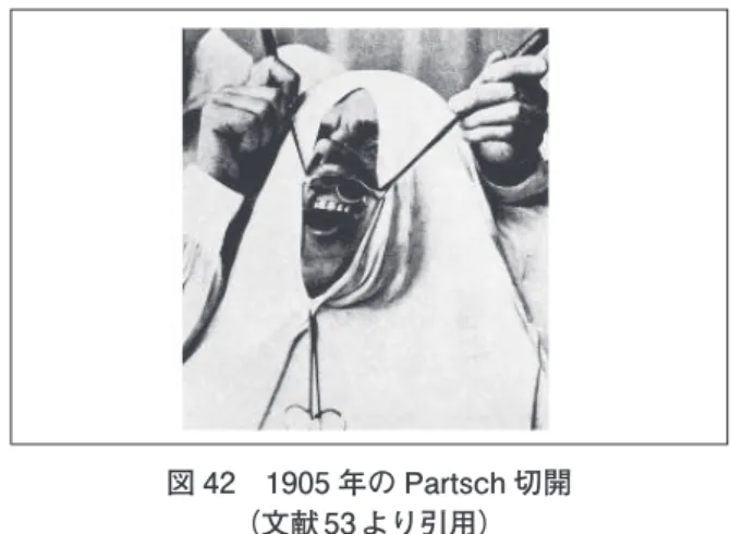図 44　Wassmund の arched incision