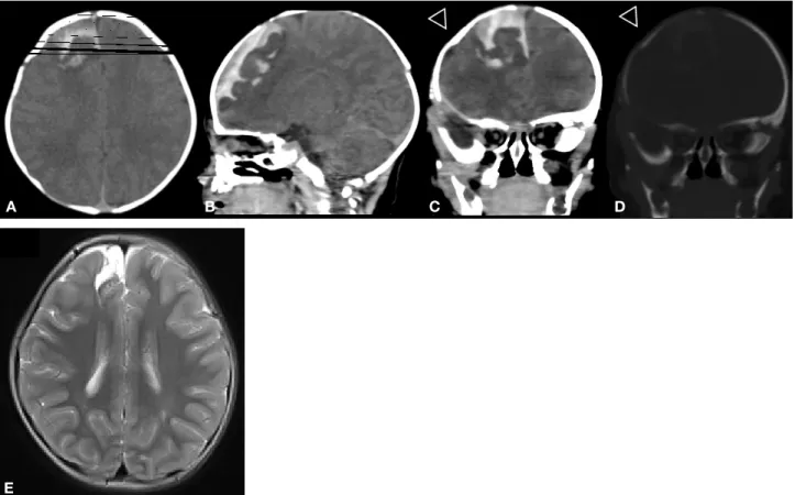 Fig. 1   Case 1. A, B, C, and D show CT images on postnatal day 2.