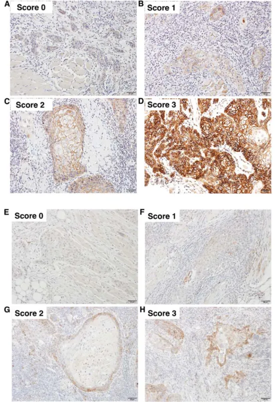 Figure 4. Immunostaining of (A-D) CD44v3 and (E-H) CD24 in OSCC tissues. The staining intensity was graded into 4 levels, i.e., 0, negative; 1, weakly  positive; 2, moderately positive; 3, strongly positive.