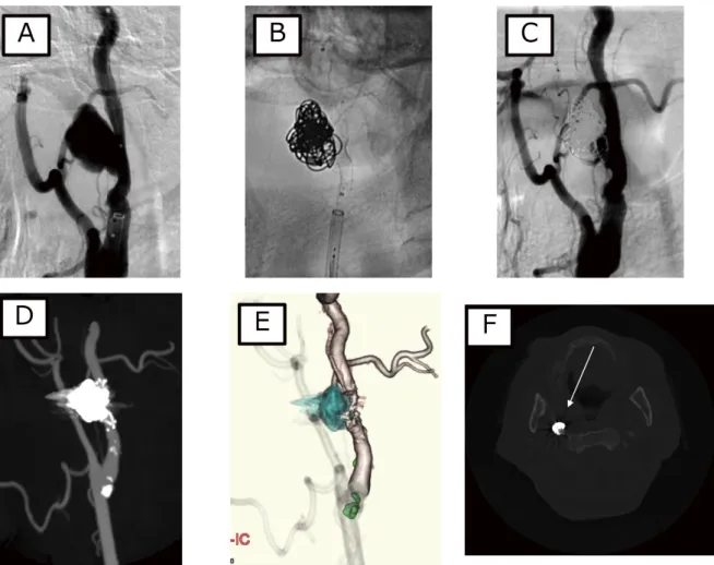 Fig. 3  Right carotid artery image pre and post stent-assisted coil embolization