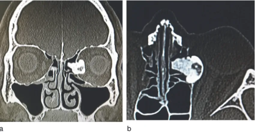 図 2 副鼻腔単純 CT 所見 左篩骨洞から眼窩内に突出する 16 mm × 14 mm の骨性腫瘤を認めた。 a：冠状断、b：水平断 図 3 副鼻腔造影 MRI 水平断：左眼窩内に突出し、左内直筋を圧排しているが連続性は認めなかった（△）。 左内直筋は造影され腫瘤との位置関係が観察しやすい。 図 5 手術所見② 左下鼻甲介前面骨で紙様板欠損部を再建した （△）。眼窩脂肪織の露出はなし。図 4手術所見①眼窩周囲の粘膜を除去し、眼窩紙様板からの癒着を解除し、骨性腫瘤（▲）を一塊として摘出 した。眼窩脂肪織の露
