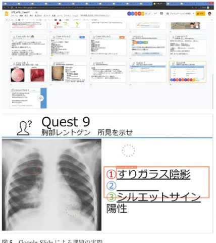 図 5 Google Slide による課題の実際 上段 ： 全ての班の進行状況を Google Slide でモニタリング可能 実際に学生が開いているスライドにアイコンが表示される 下段 ： 複数の学生が同時にスライドに回答記入や病変部位の図示が可能 表 1–1 総括アンケートの質問項目 (2019 年度，2020 年度で共通) 質問項目 評価方法 1の選択肢の定義 5の選択肢の定義 PBL方式について 5段階評価 通常の講義形式の方が学習効果が高いと感じる PBL形式の方が学習効果が高いと感じる ペーパ
