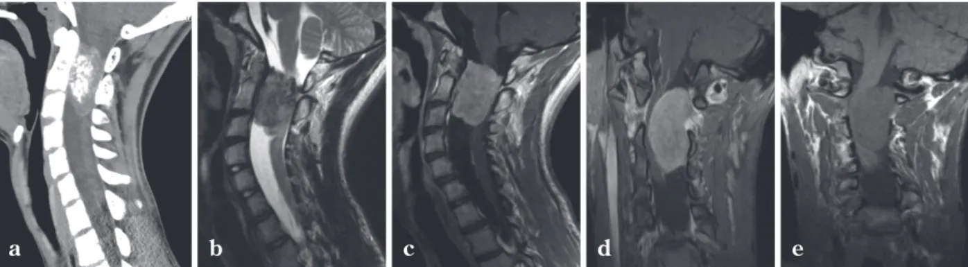 Fig.　1　Computed tomography（CT）scan and magnetic resonance imaging（MRI）in the initial presentation a ：Sagittal CT shows a tumor with calcification and an enlargement of the spinal canal at C2 level.