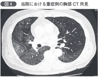 図 4   当院における重症例の胸部 CT 所見