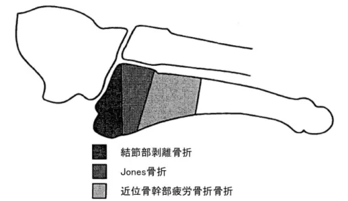 図 2： 骨 折 部 位 と 骨 折 タ イ プ [ 13]     近 位 骨 幹 部 疲 労 骨 折 の 予 後 が 不 良 で あ る 原 因 を 探 る た め に ， Smi t h ら は 第 5 中 足 骨 に 血 液 供 給 を す る 血 管 の 解 剖 学 的 な 特 徴 に つ い て 報 告 し た [ 14] ． ① 結 節 部 剥 離 骨 折 や ② Jo ne s 骨 折 で は 骨 折 が 発 生 し た と し て も 近 位 側 ，遠 位 側 か ら の 豊 富 な 血 