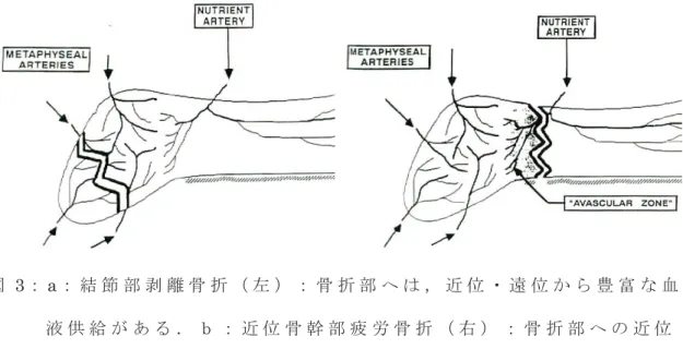 図 3： a： 結 節 部 剥 離 骨 折 （ 左 ） ： 骨 折 部 へ は ， 近 位 ・ 遠 位 か ら 豊 富 な 血 液 供 給 が あ る ． ｂ ： 近 位 骨 幹 部 疲 労 骨 折 （ 右 ） ： 骨 折 部 へ の 近 位 か ら の 血 液 供 給 は 無 く ，遠 位 か ら の 血 液 供 給 は 内 側 の み と な る [ 14]    図 4： Jo nes 骨 折 の ス ポ ー ツ 別 発 生 件 数 ・ 発 生 頻 度 [ 6]  0 100 200 300  400