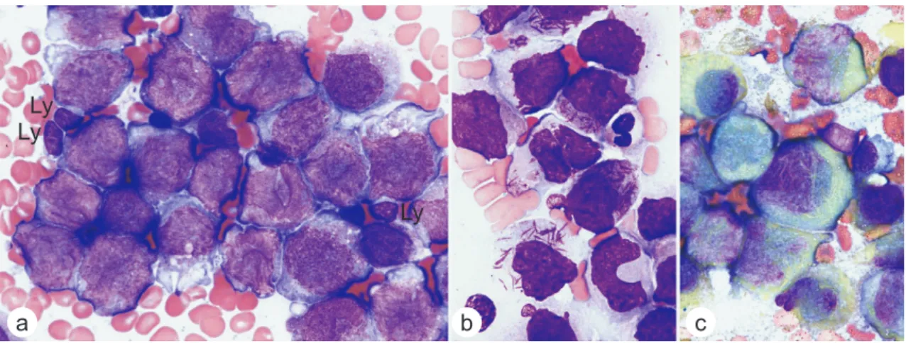 Figure 1. Morphology of leukemia cells in the BM. (A) Wright-stained leukemia cells. Three reactive lymphocytes (Ly) are indicated as  a size reference for leukemia cells