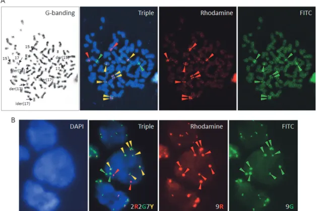 Figure 3. FISH using the Vysis LSI PML/RARA dual-color, dual-fusion translocation probe kit, consisting of red-labeled PML and green- green-labeled RARA probes (Abbott Laboratories, Abbott Park, IL)