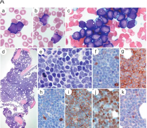 Figure 2. Appearance of peripheral blood  (PB) and bone marrow (BM).