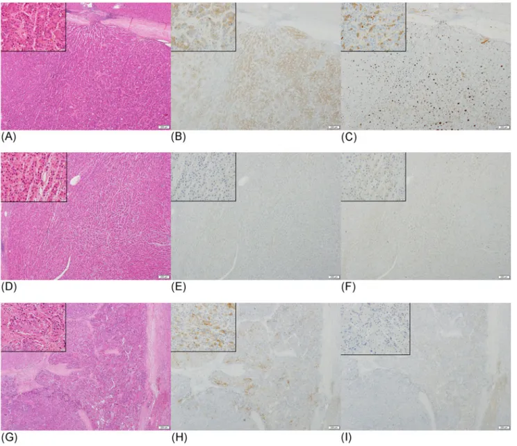 Fig 1. Immunostaining of DCP and NX-DCP in well, moderately, and poor differentiated HCCs