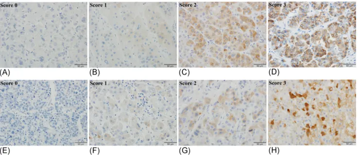 Fig 2. Immunostaining of DCP (A-D) and NX-DCP (E-H) in HCC tissues. The staining intensity was graded into 4 levels, i.e., 0, negative; 1, weakly positive; 2, moderately positive; 3, strongly positive.