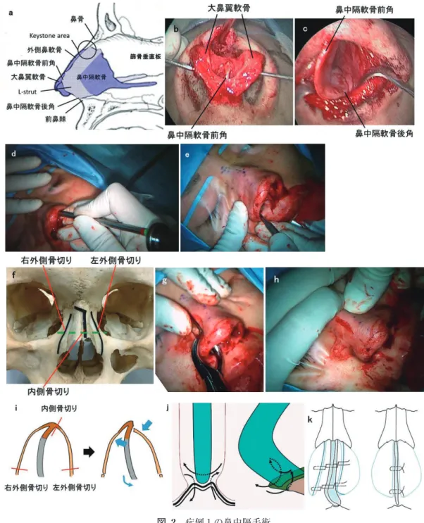 図 2 症例 1 の鼻中隔手術 a： 鼻中隔および周囲の解剖模式図（文献 2 より改変）。鼻中隔軟骨尾側端の上端が鼻中隔軟骨前 角であり，下端が鼻中隔軟骨後角である。鼻中隔軟骨の鼻背，尾側部 10‑15mm は，鞍鼻・鼻 尖下垂を起こさないために残すべき部分であり L-strut といわれる。また鼻中隔軟骨と篩骨垂 直板の接合部は，上方で鼻骨に付着している。この部位は鼻背の構造の維持に重要であり keystone area といわれ，軟骨が鼻骨から外れると鞍鼻をきたす。 b： 大鼻翼軟骨の間に鼻中隔軟骨前角
