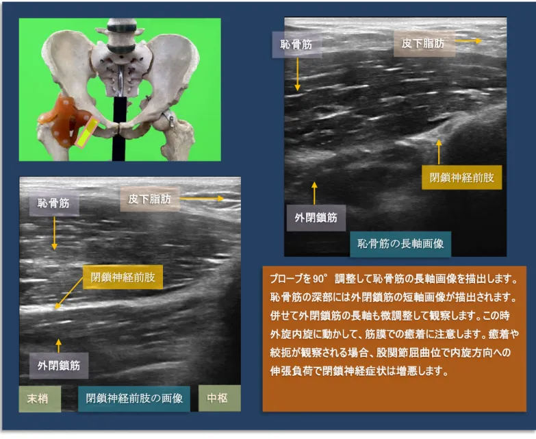 図  股関節前方の超音波観察法  短軸画像によるスカルパ三角の全体像 図  股関節前方の観察法  恥骨筋と外閉鎖筋、閉鎖神経について   次に、股関節屈曲外旋位で恥骨筋を緩めておき、恥骨筋長軸の深部にある外閉鎖筋の短 軸画像の観察を行います。 外閉鎖筋の筋断裂などの損傷はサッカー選手に割と多く、内閉鎖筋と共に注意を要する 部位です。ある発表では、閉鎖筋損傷の全例で他動的に股関節を外転内旋位で疼痛が誘発恥骨筋 外閉鎖筋 皮下脂肪 恥骨筋 外閉鎖筋 皮下脂肪  閉鎖神経前肢  プローブを 90°調整して恥骨筋の