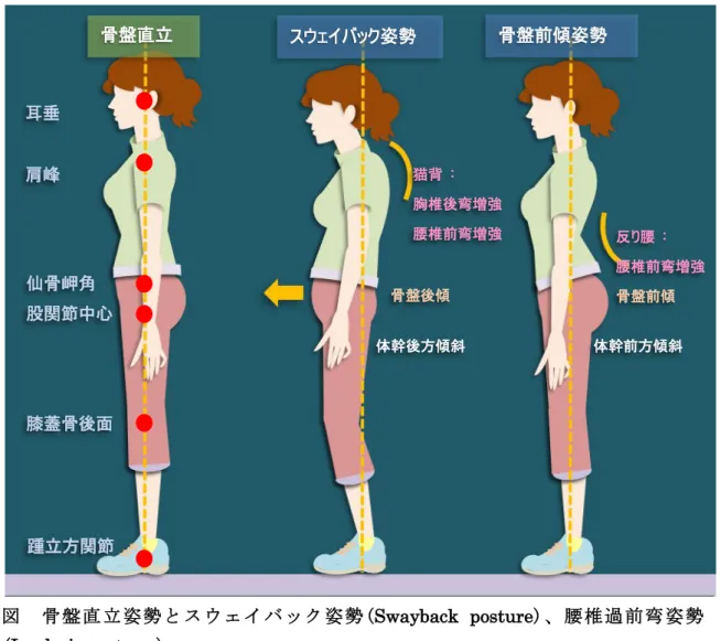 図   骨 盤 直 立 姿 勢 と スウ ェ イ バ ッ ク 姿 勢 ( Swayback  posture)、腰椎過前弯姿勢 ( Lordosis posture )    股関節前方部痛を訴える患者さんは、しばしば異常姿勢で歩くことが知られています。 そして、姿勢が矯正されることでその痛みが軽減できることも、日常的に感じられている と思います。  姿勢の問題をチェックする場合には、矢状面での重心線の通る位置以外にも、前額面で のバランスや、特に筋節の長さの違いは十分に着目すべき点となります。  スウェイ