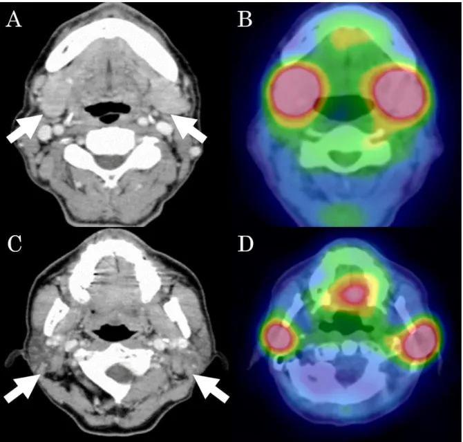 Fig. 1 Contrast-enhanced CT shows slight enlargement of the submandibular (A,  arrows) and parotid (C, arrows) glands