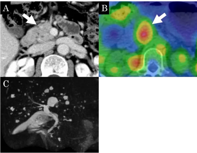 Fig. 2 While contrast-enhanced CT does not indicate pancreatic enlargement (A,  arrow), a  67 Ga SPECT/CT shows accumulation in the remnant pancreas after resection  (B, arrow)