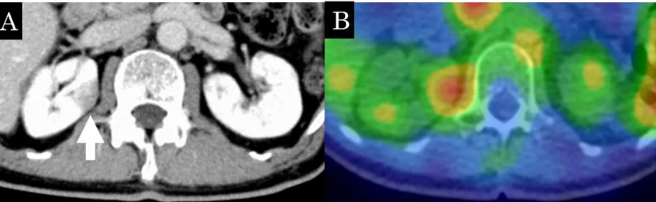 Fig. 3  The wedge-shaped low density area is seen on contrast-enhanced CT (A,  arrow), suggesting interstitial nephritis