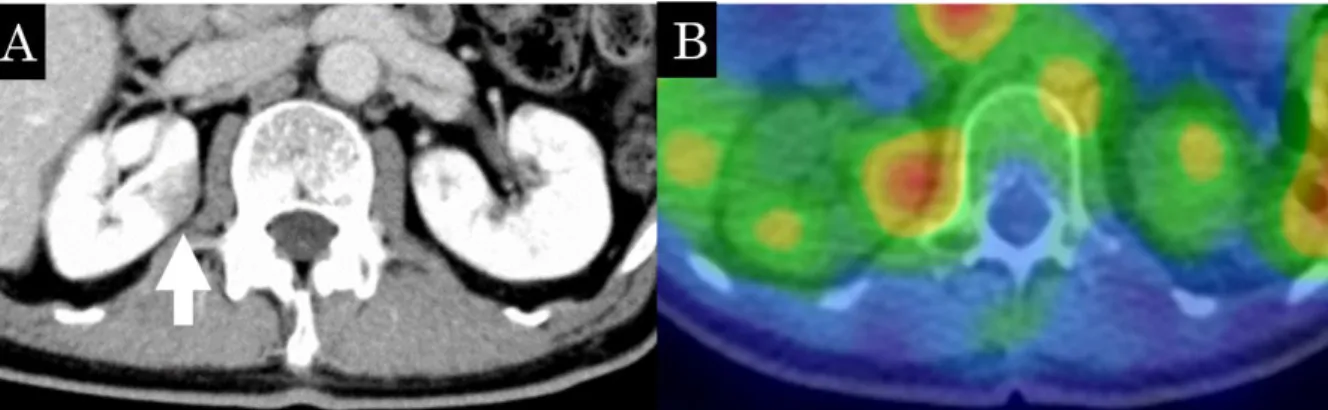 Fig. 3  The wedge-shaped low density area is seen on contrast-enhanced CT (A,  arrow), suggesting interstitial nephritis