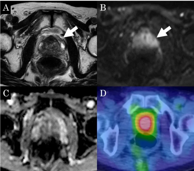 Fig. 4 An MRI showed low signal intensity on T2WI (A, arrow) and mild high signal  intensity on the diffusion-weighted image (B, arrow), suggesting prostatitis