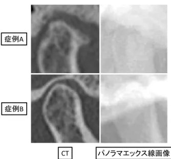 図 4 症例 A：変形のある症例（osteophyte）で歯科放射線 医は誤ったが，人工知能は正しく診断できた症例。症 例 B：変形のない症例で歯科放射線医は正しく診断で きたが，人工知能は誤って診断した症例⑕౛A⑕౛BCT 䝟䝜䝷䝬䜶䝑䜽䝇⥺⏬ീ をもたせるものと考えられる。さらに異なるパノラマ装 置によって得られた画像を多くの施設から収集すること で診断能の向上が可能になると思われる。 結 語 パノラマエックス線画像による診断に深層学習を利用 した人工知能を適用して，変形性顎関節症の診断能を検 証した。