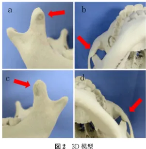 図 1 術前パノラマエックス線写真，CT 写真 a，b，c：両側筋突起の頰骨弓上縁を越える過形成を認め る。d，e：両側下顎頭の皮質骨形態は明瞭で，骨破壊や変 形，骨性癒着を疑う所見は認めない。  図 2 3D 模型 a，c：両側筋突起の前縁に陥凹を認める（赤矢印）。b，d：開口位において両側筋突起と頰骨弓内面との干渉が確認できる（赤矢印）。 現 症：全身所見；身長 125.8 cm，体重 25.6 kg。四肢 体幹に異常は認めなかった。 局所所見；顔貌は左右対称で，咬筋肥大は認めず， square man