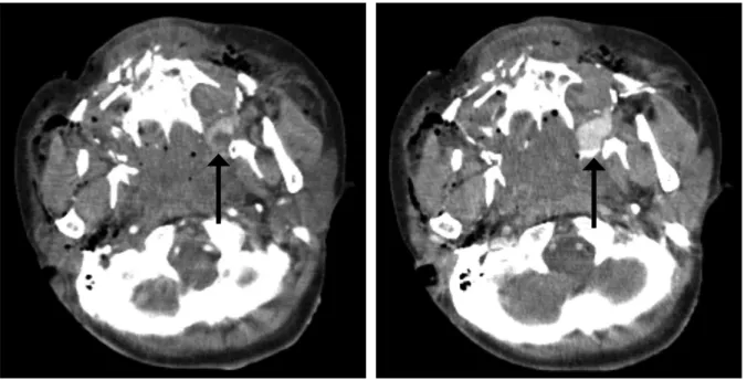 Fig. 2.   Contrast enhanced computed tomography showing contrast medium extravasation at dorsal left maxil- maxil-lary sinus (black arrow).