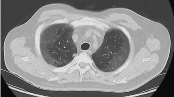 Fig. 2  Computed tomography angiography showing acute occlusion of the right iliac artery, distal right profunda femoris artery, and popliteal artery (A,  white arrows), a focal aortic thrombus at the level of the inferior mesenteric artery (B, white arrow