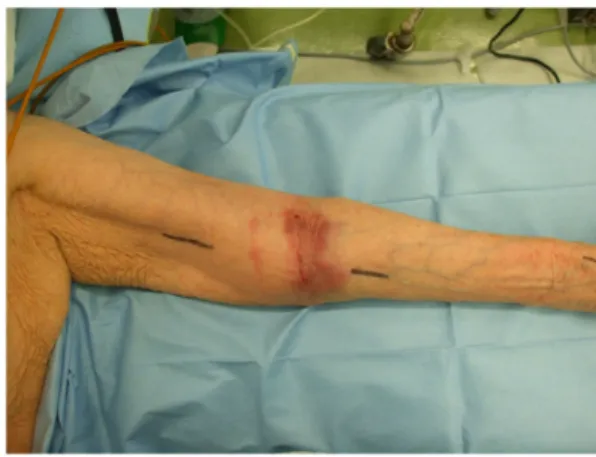 Fig. 1  Swelling and an internal hemorrhage in the vicinity of the left  upper arm elbow joint.