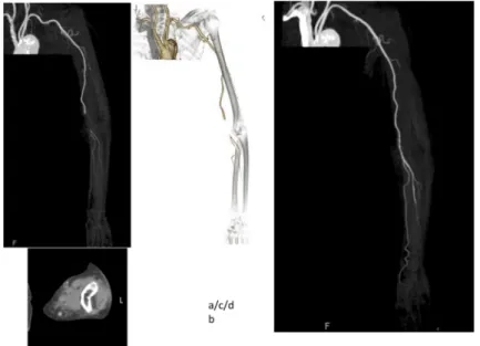 Fig. 3  Upper: Operation view color change show in brachial artery. 